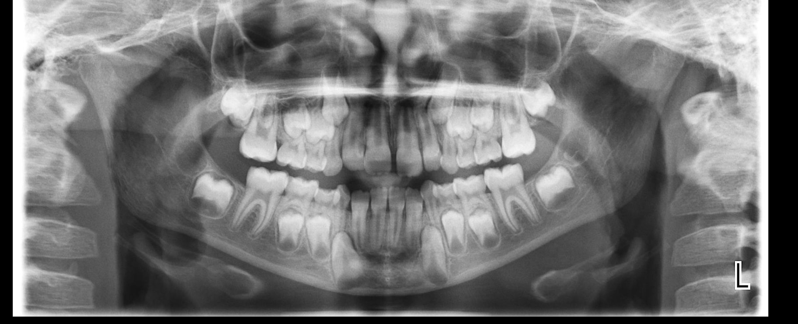Case 1 - Identify the Teeth using FDI numbers