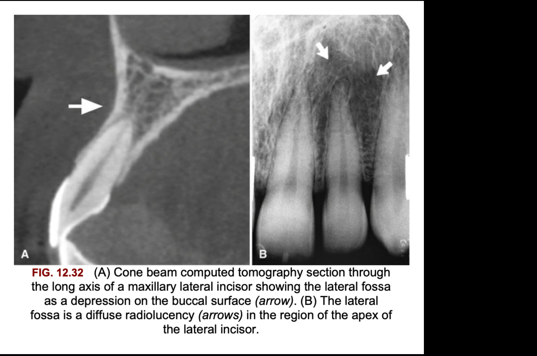 FIG. 12.32 (A) Cone beam computed tomography section through the long axis of a maxillary lateral incisor showing the lateral fossa as a depression on the buccal surface (arrow). (B) The lateral fossa is a diffuse radiolucency (arrows) in the region of the apex of the lateral incisor.