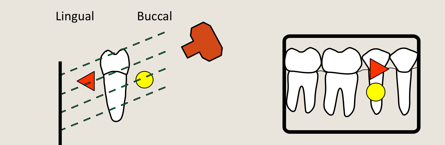 INCREASE VERTICAL ANGULATION (Ascending)