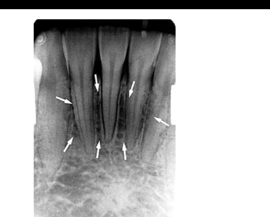 FIG. 12.53 The mental fossa is a depression on the anterior surface of the mandible and is seen as a radiolucent area with ill-defined borders (arrows) in the region of the incisor roots.