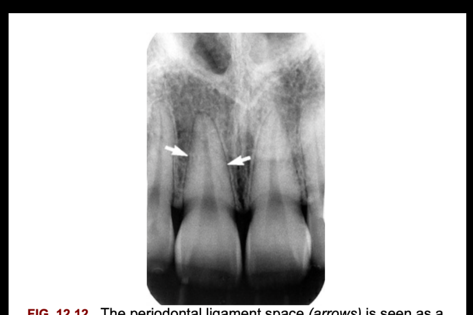 FIG. 12.12 The periodontal ligament space (arrows) is seen as a narrow radiolucency between the tooth root and the lamina dura.