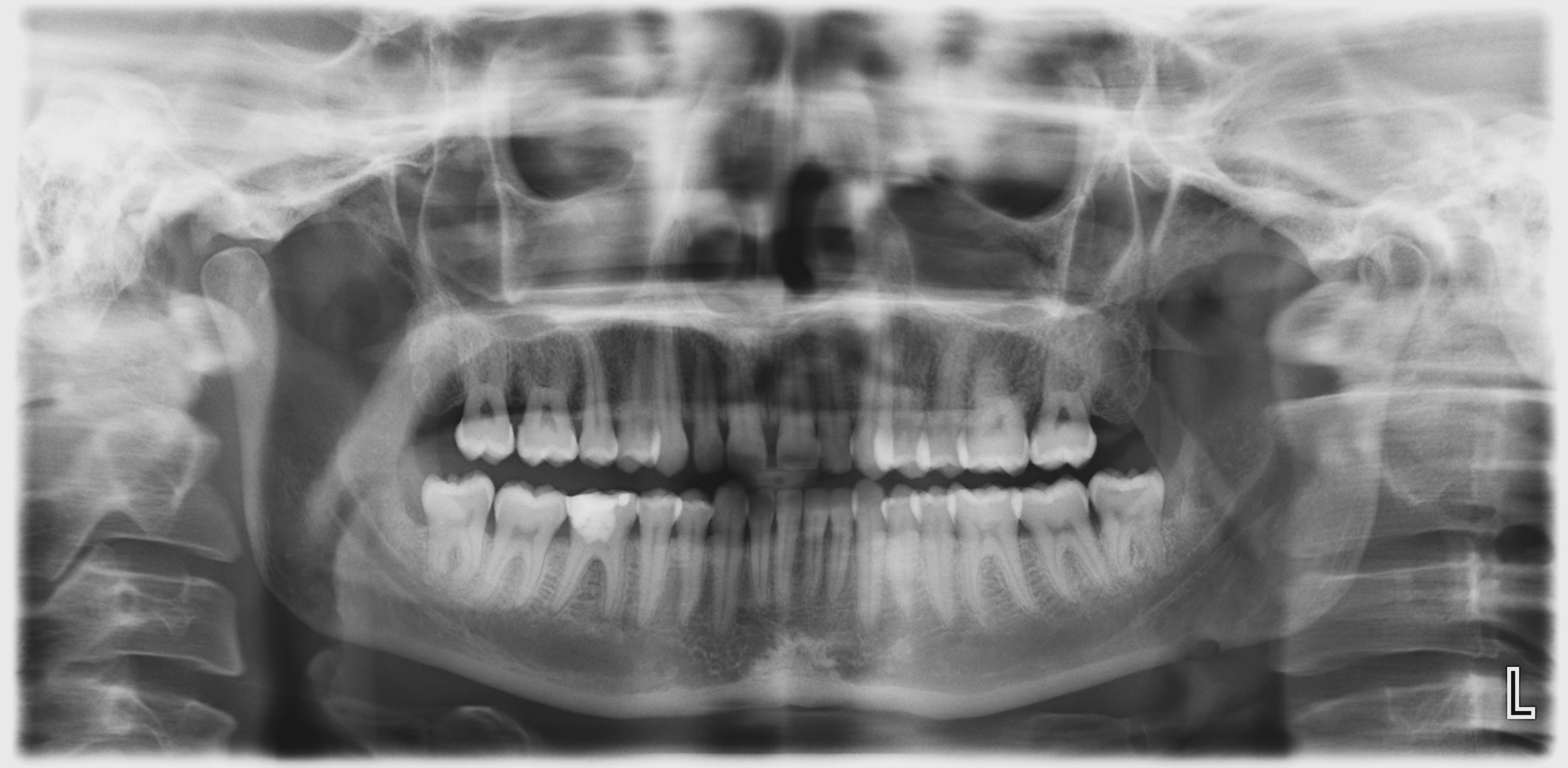 Episodic Pain from Mandibular Third Molars
