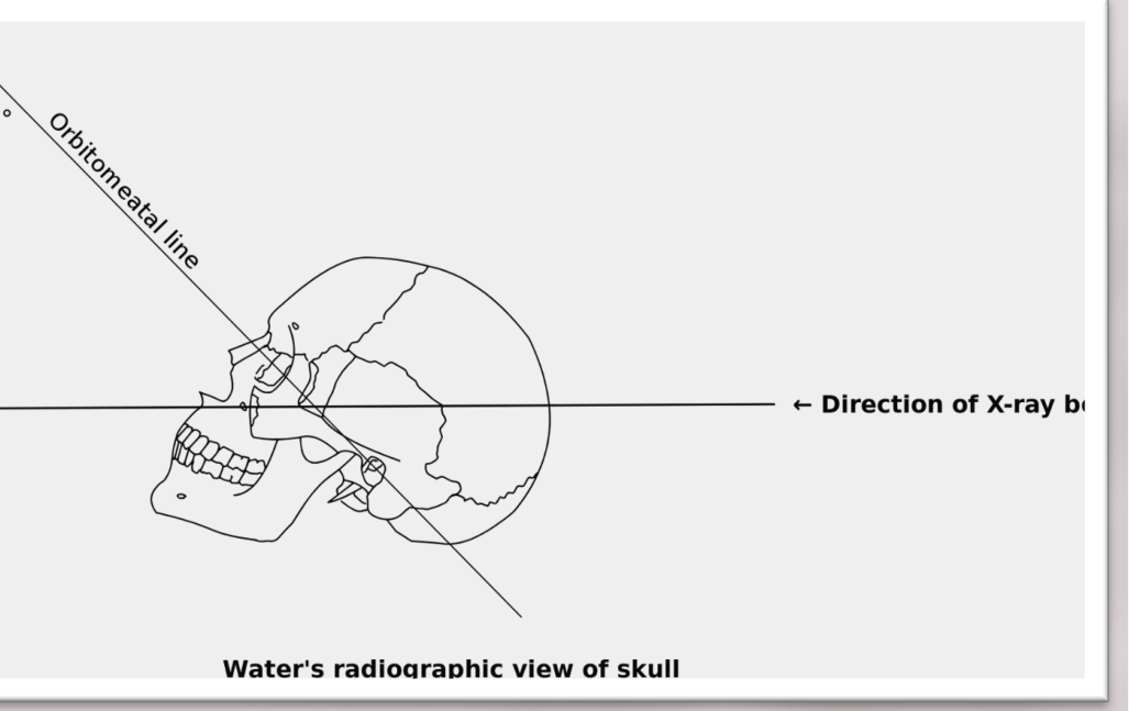 Water's radiographic view of skull