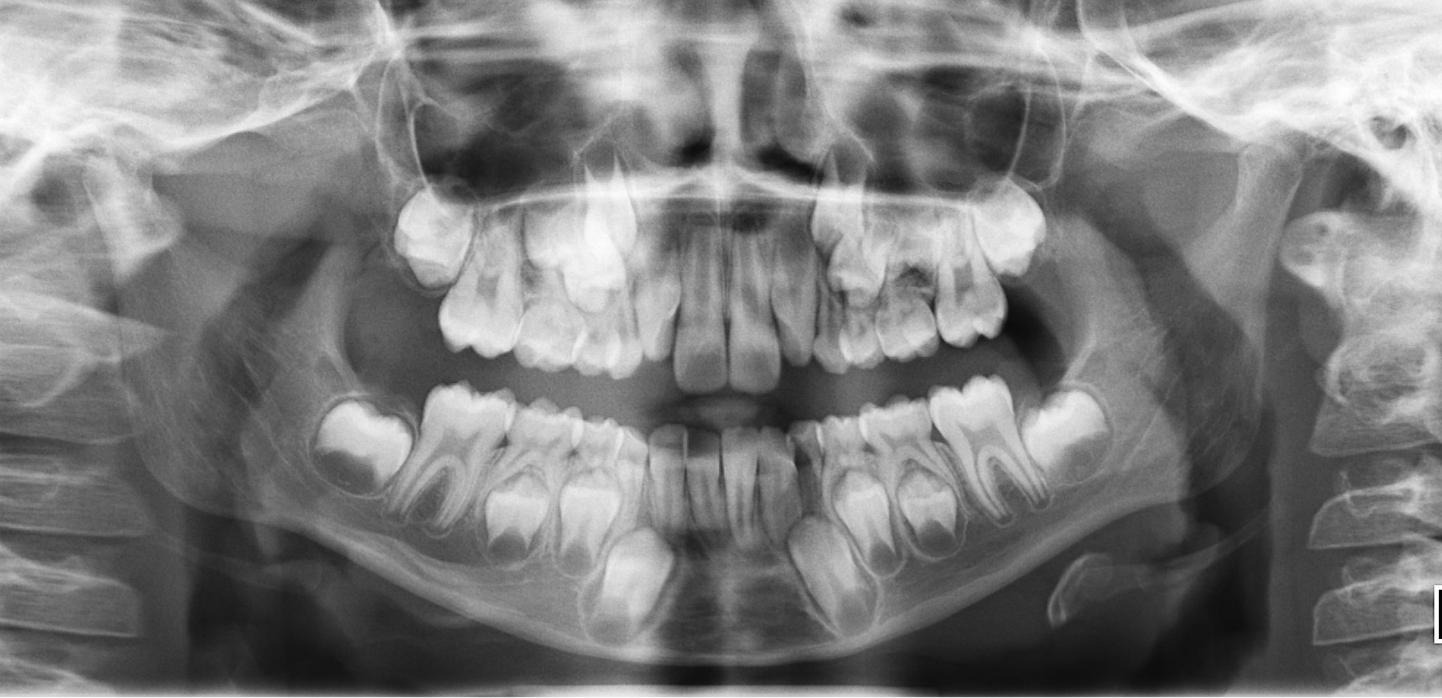 Mixed dentition – Permanent Teeth Development and Position