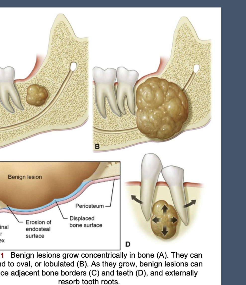 FIG. 24.1 Benign lesions grow concentrically in bone (A). They can be round to oval, or lobulated (B). As they grow, benign lesions can displace adjacent bone borders (C) and teeth (D), and externally resorb tooth roots.