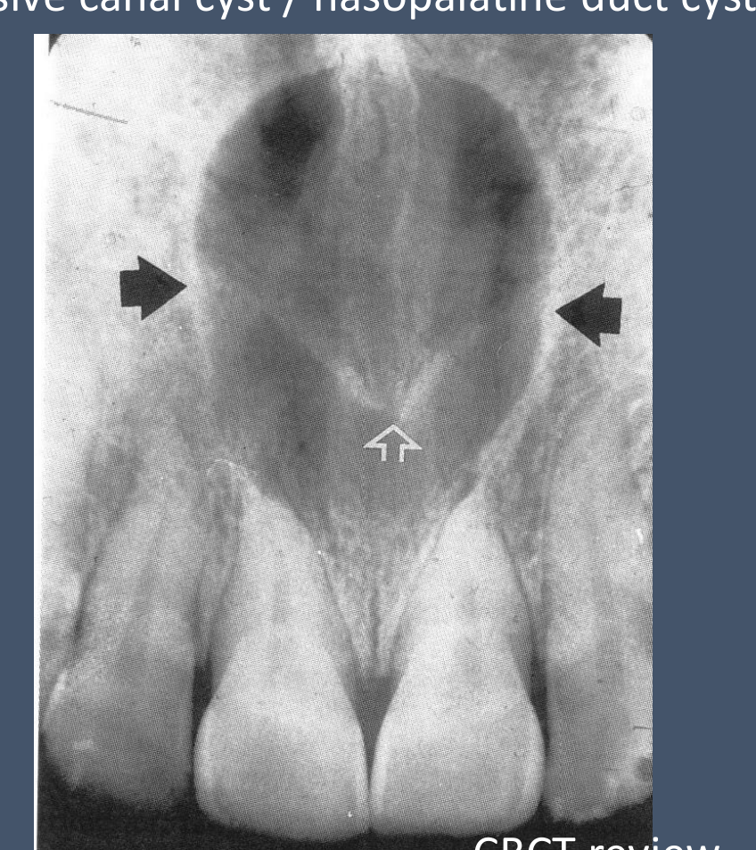 Incisive canal cyst / nasopalatine duct cyst