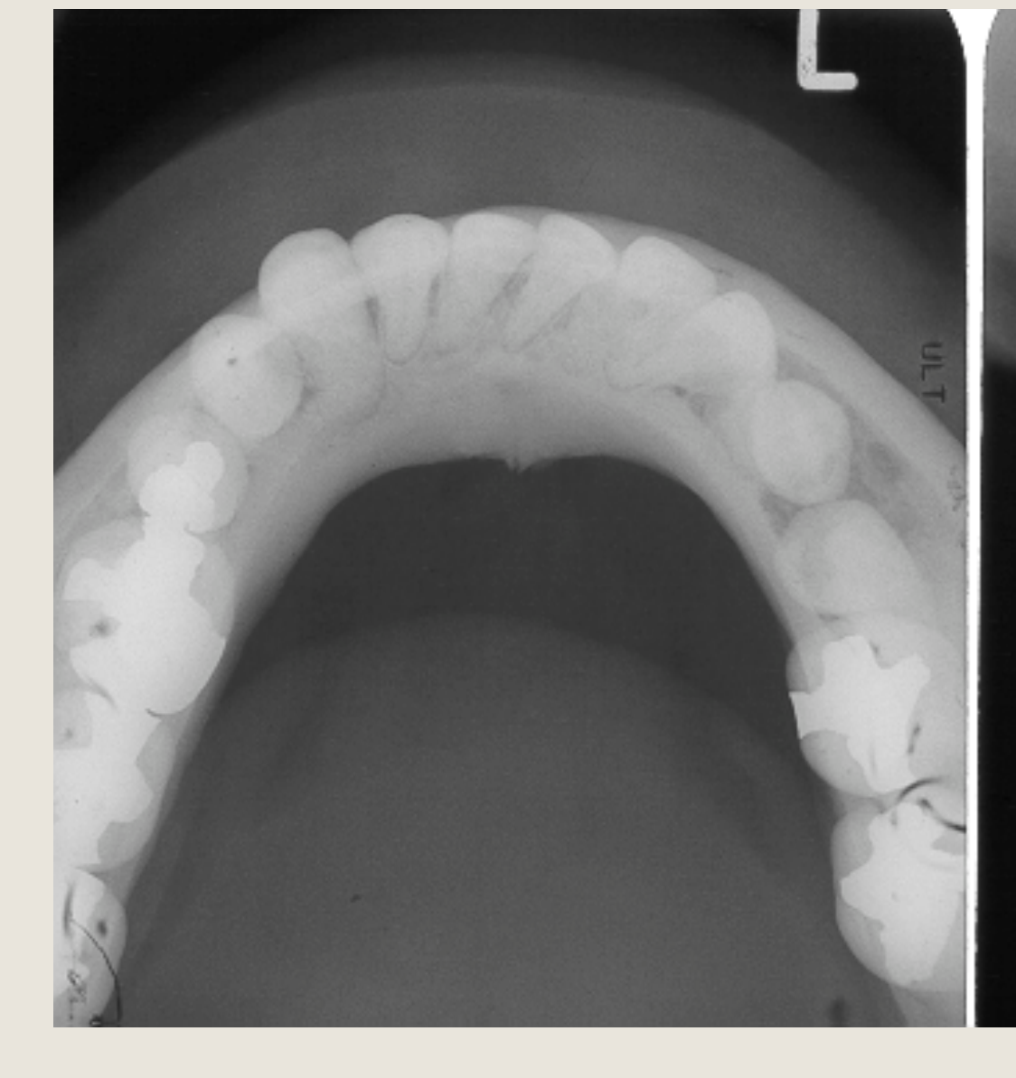 Mandible