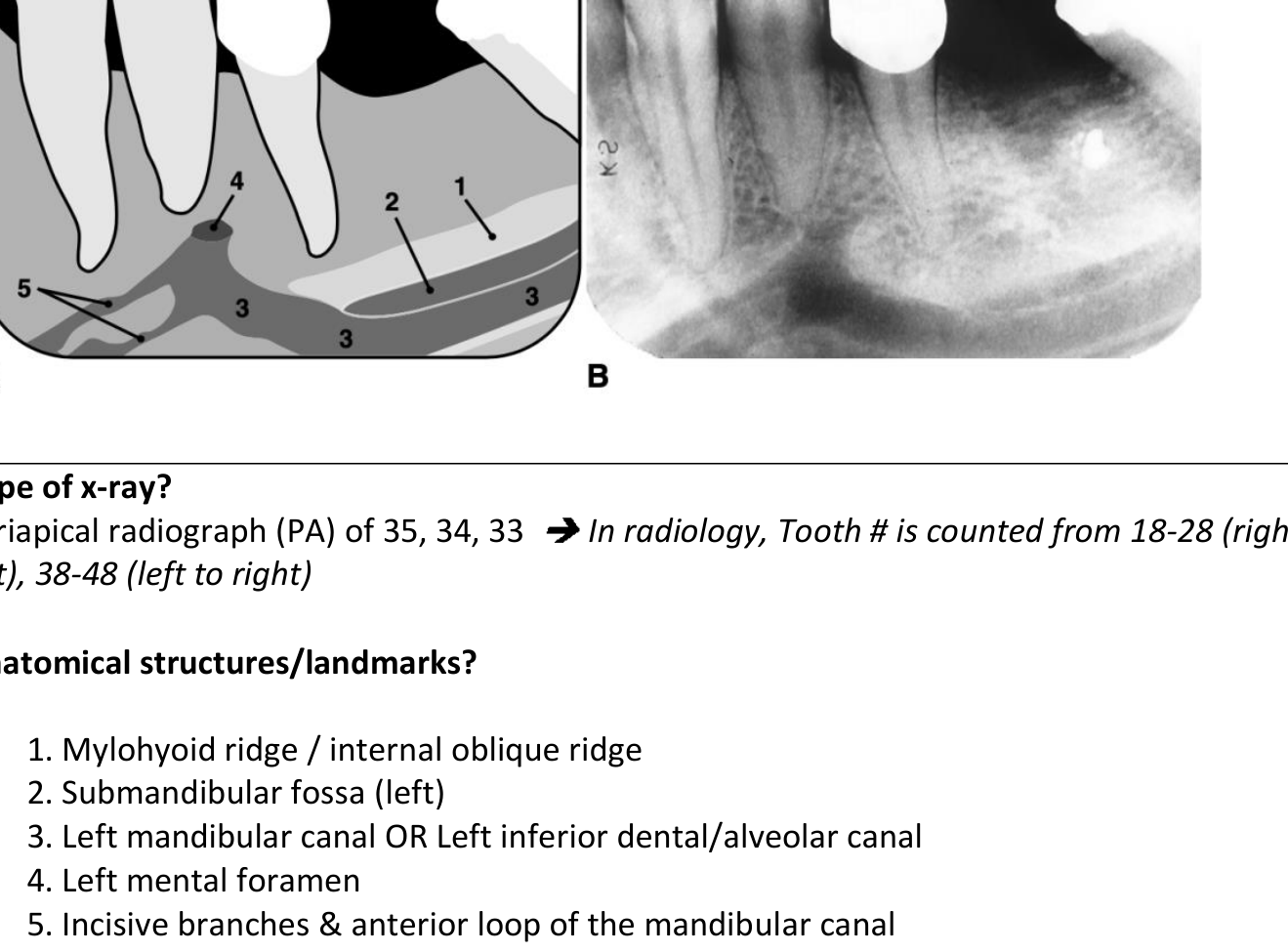 A: Diagram showing labelled anatomical landmarks; B: Corresponding periapical radiograph.