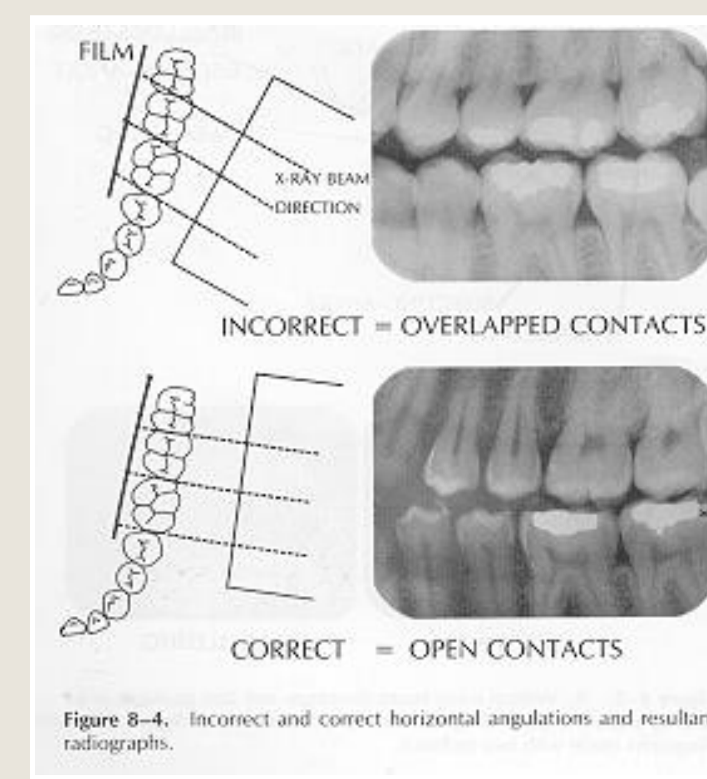 Figure 8-4. Incorrect and correct horizontal angulations and resultant radiographs.
