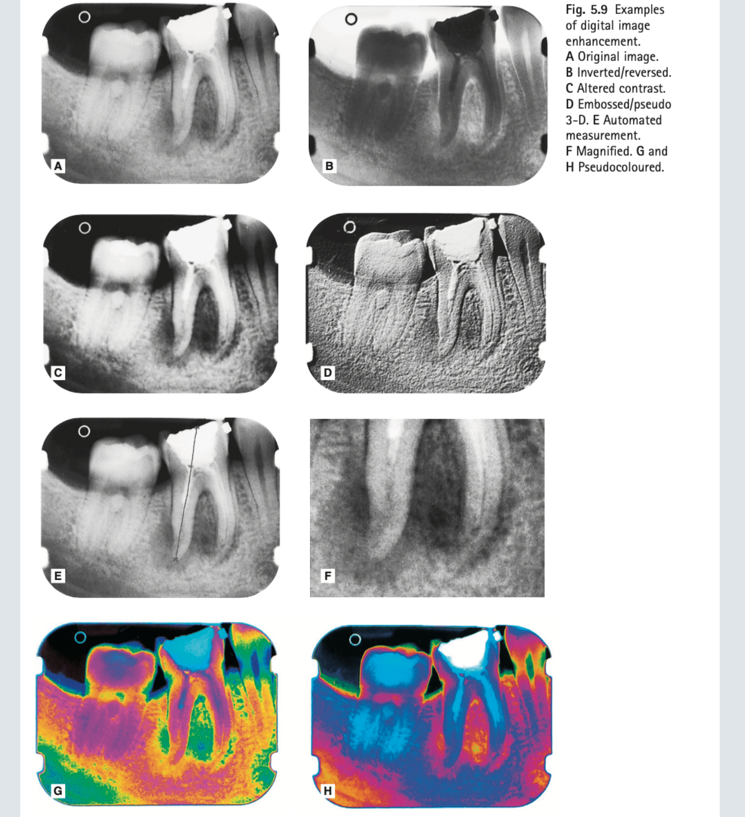 Fig. 5.9 Examples of digital image enhancement. A Original image. B Inverted/reversed. C Altered contrast. D Embossed/pseudo 3-D. E Automated measurement. F Magnified. G and H Pseudocoloured.