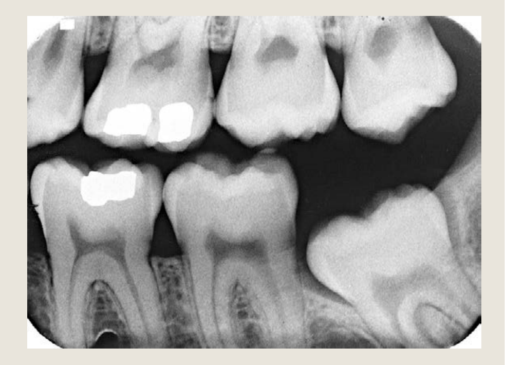 Left Posterior Bitewing (BW)
