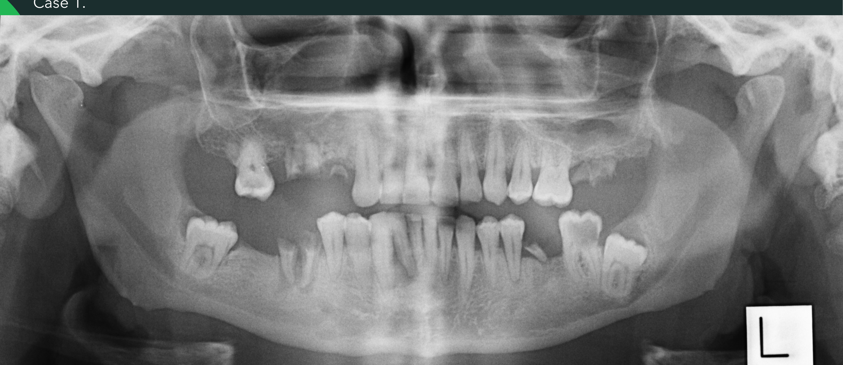 Case 1. Reason for Scan: Heavily compromised dentition