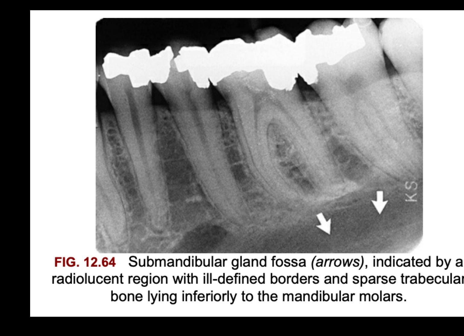 FIG. 12.64 Submandibular gland fossa (arrows), indicated by a radiolucent region with ill-defined borders and sparse trabecular bone lying inferiorly to the mandibular molars.
