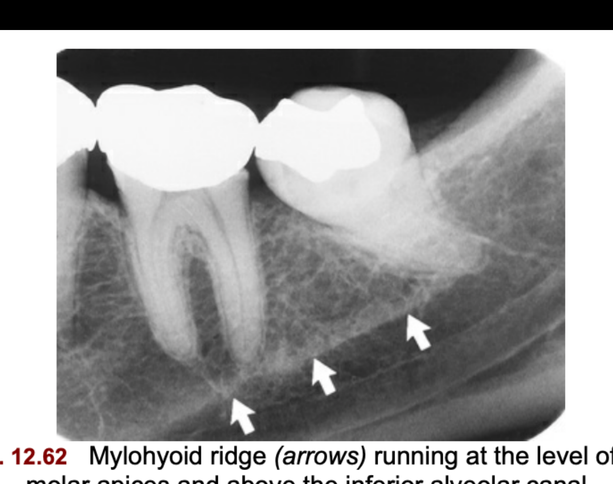 FIG. 12.62 Mylohyoid ridge (arrows) running at the level of the molar apices and above the inferior alveolar canal.