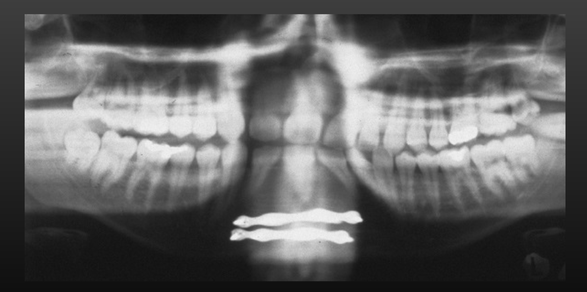 Teeth behind the focal trough