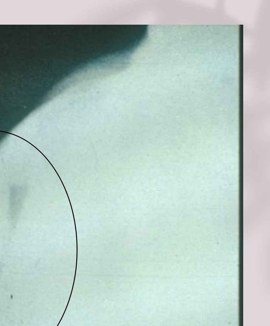 Right zygomatic arch fracture