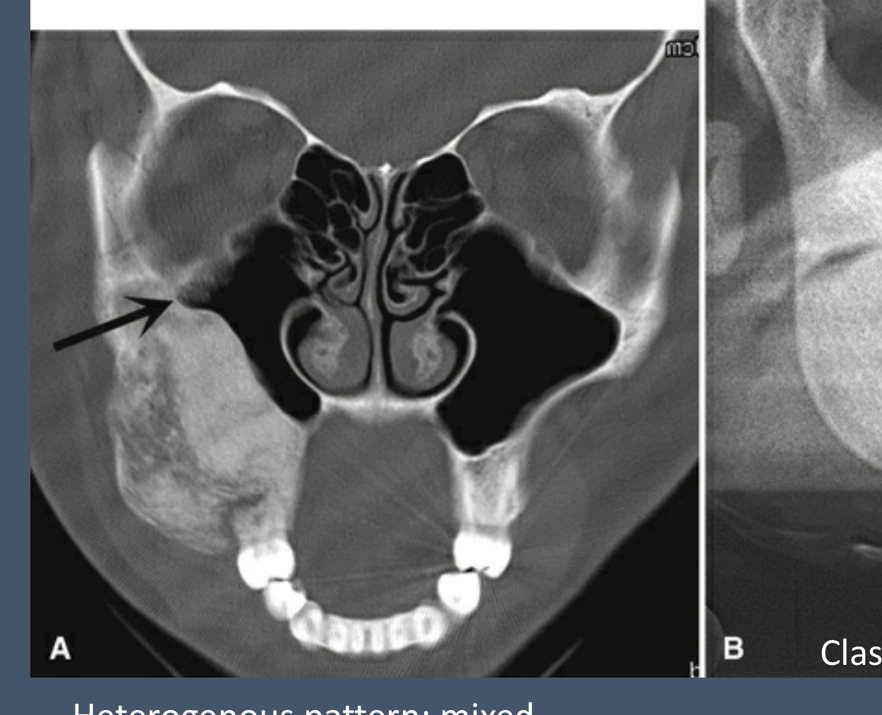 A. Heterogenous pattern; mixed hypodensity & ground-glass bone