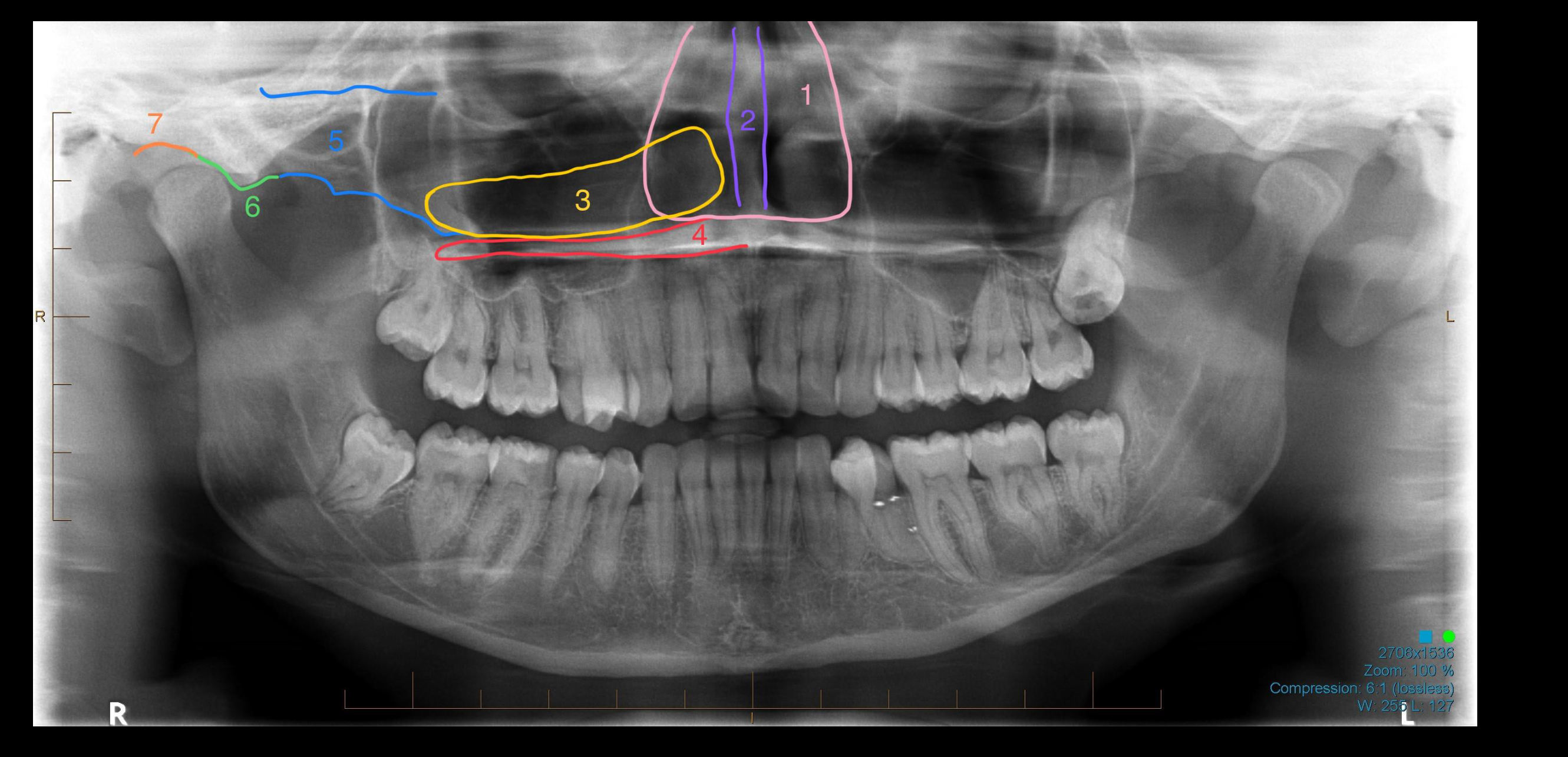 Case 5b – Midface Structures