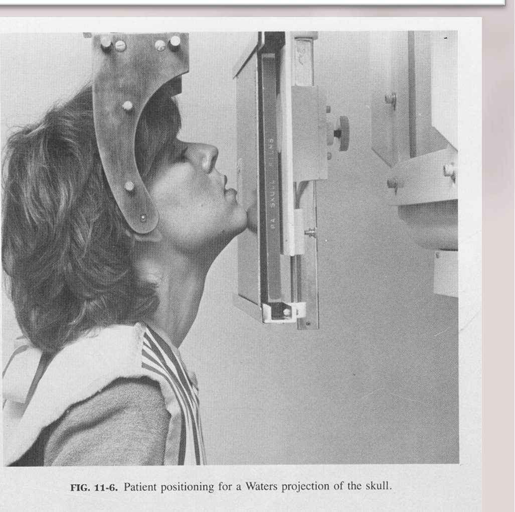 FIG. 11-6. Patient positioning for a Waters projection of the skull.