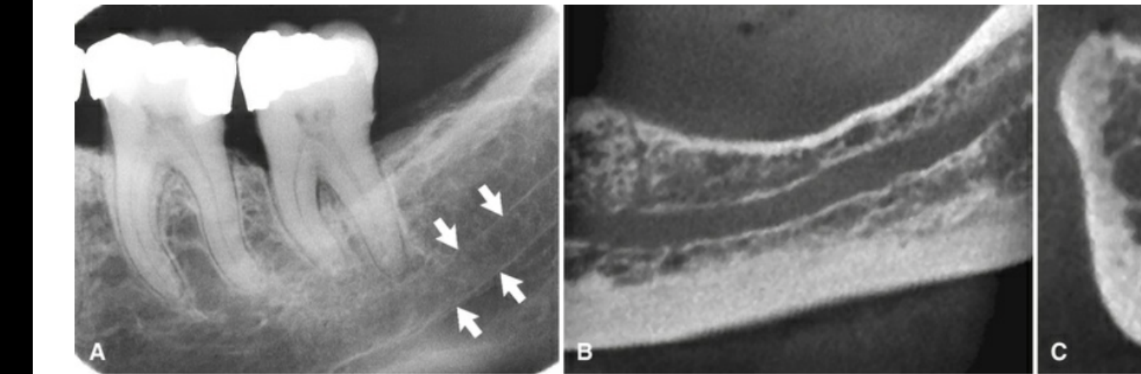 FIG. 12.57 Inferior alveolar canal. (A) On periapical view, arrows denote radiopaque superior and inferior cortical borders. (B) Cone beam section through the body of the mandible (different patient) shows corticated borders of the inferior alveolar canal. (C) Cone beam cross-sectional view shows the circular inferior alveolar canal with corticated borders lying adjacent to the lingual plate.