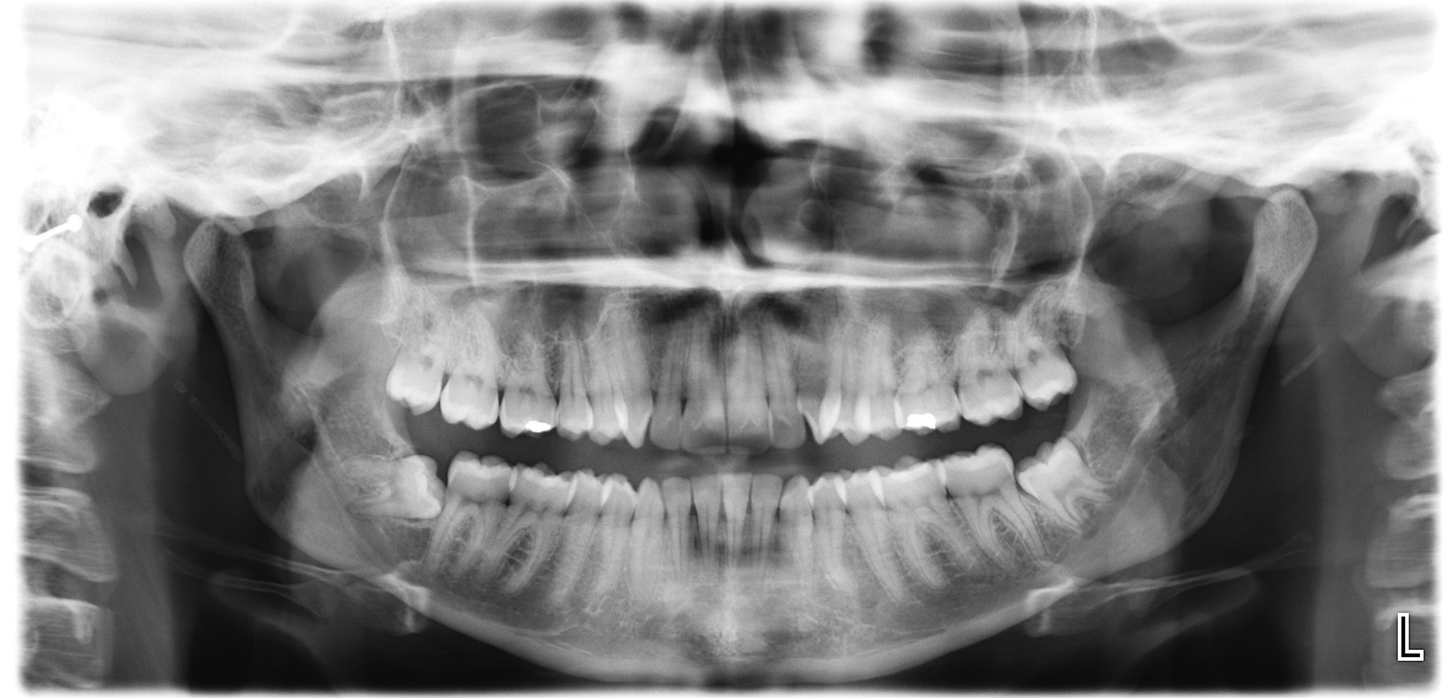 Impacted third molars #
