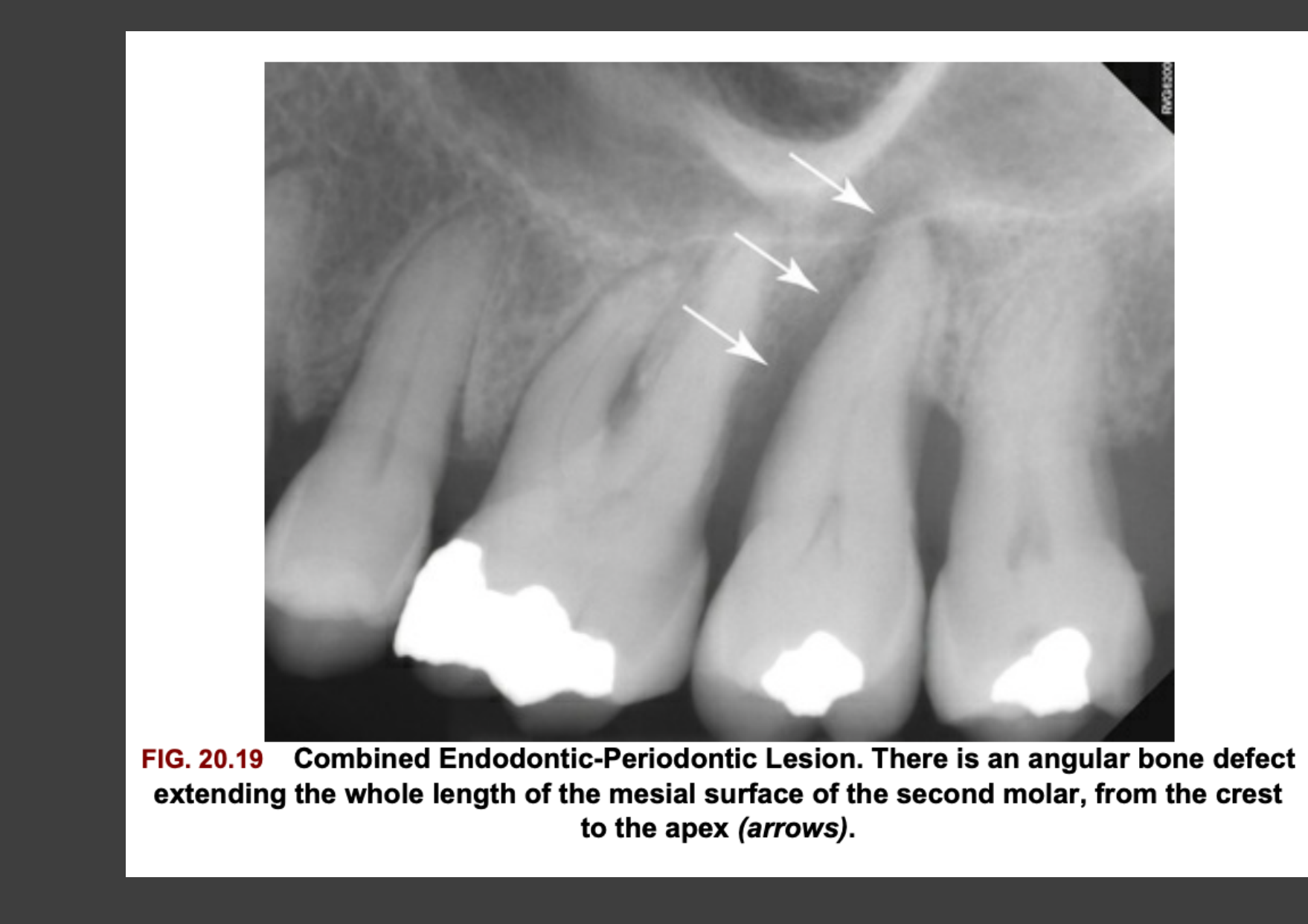 FIG. 20.19 Combined Endodontic-Periodontic Lesion. There is an angular bone defect extending the whole length of the mesial surface of the second molar, from the crest to the apex (arrows).