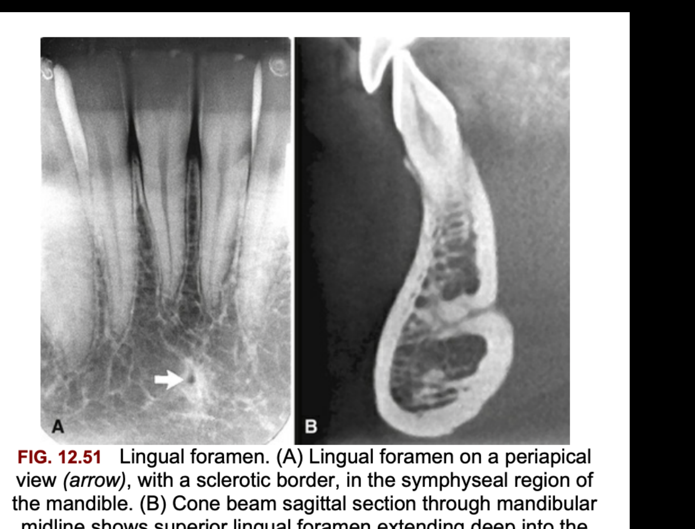 FIG. 12.51 Lingual foramen. (A) Lingual foramen on a periapical view (arrow), with a sclerotic border, in the symphyseal region of the mandible. (B) Cone beam sagittal section through mandibular midline shows superior lingual foramen extending deep into the mandible from the lingual surface.