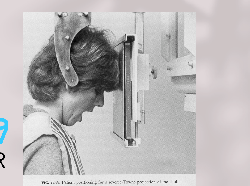 FIG. 11-b. Patient positioning for a reverse-Towne projection of the skull.