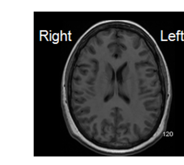 MRI images
