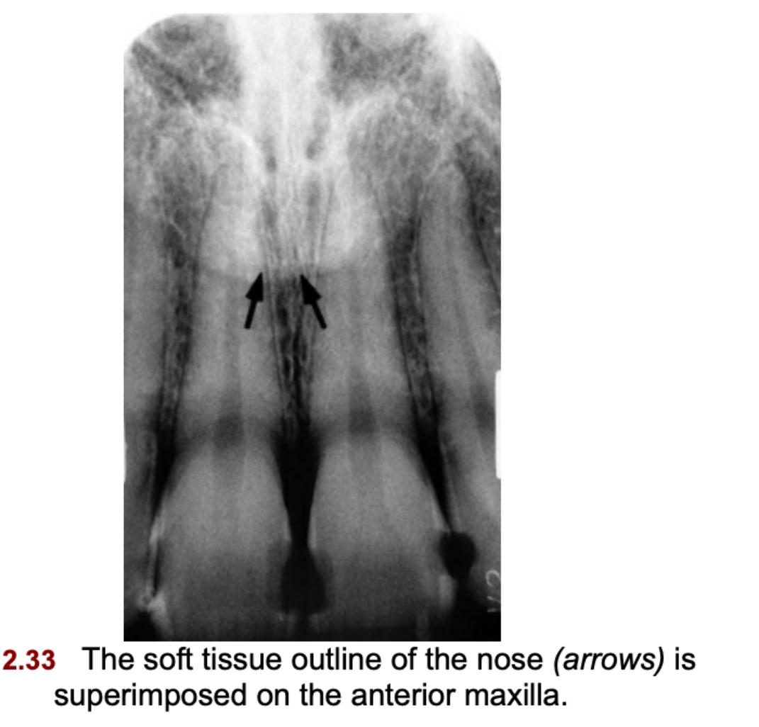 FIG. 12.33 The soft tissue outline of the nose (arrows) is superimposed on the anterior maxilla.