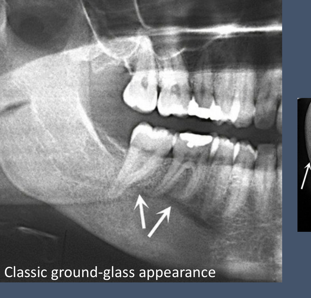 B. Classic ground-glass appearance