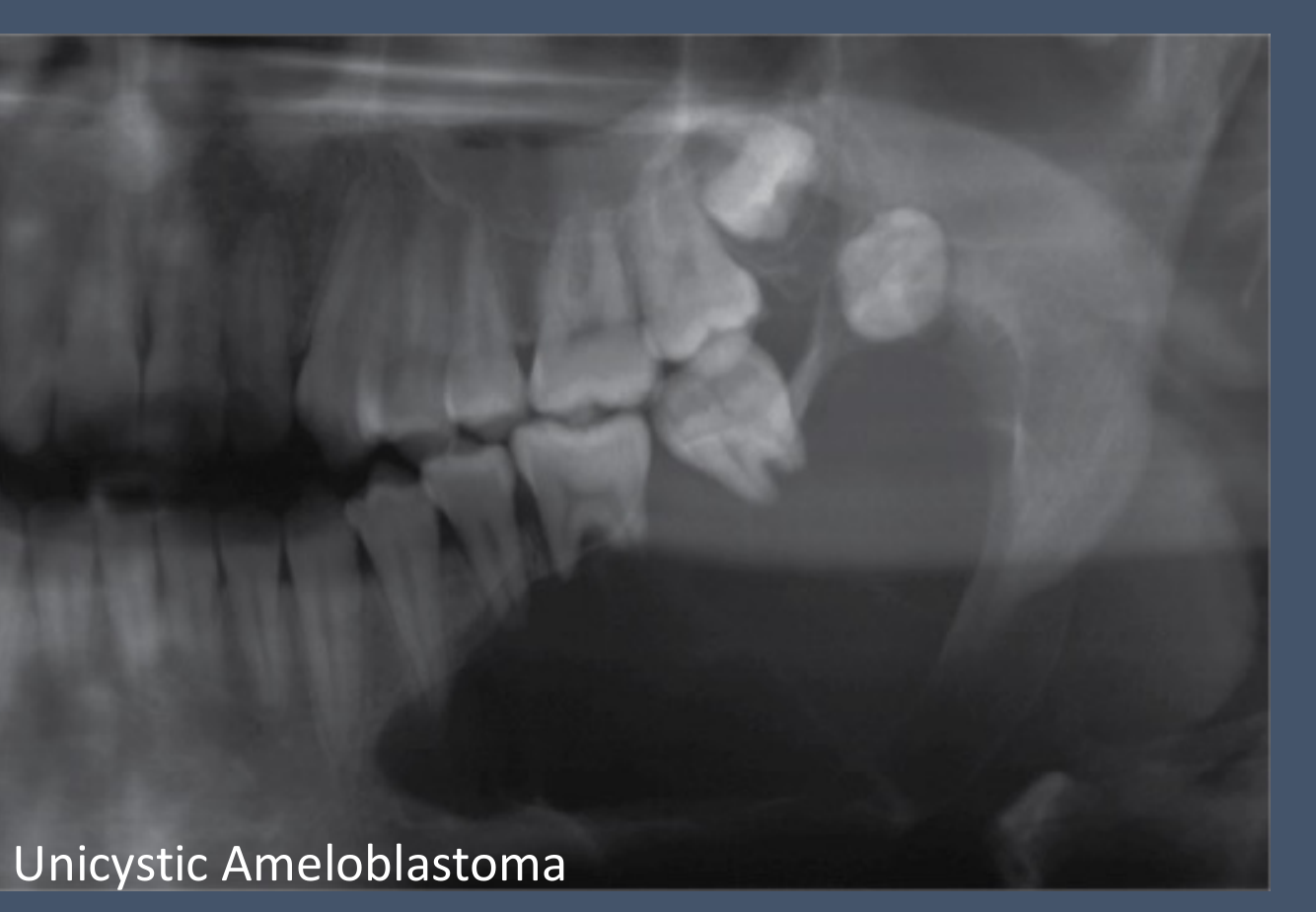 Unicystic Ameloblastoma