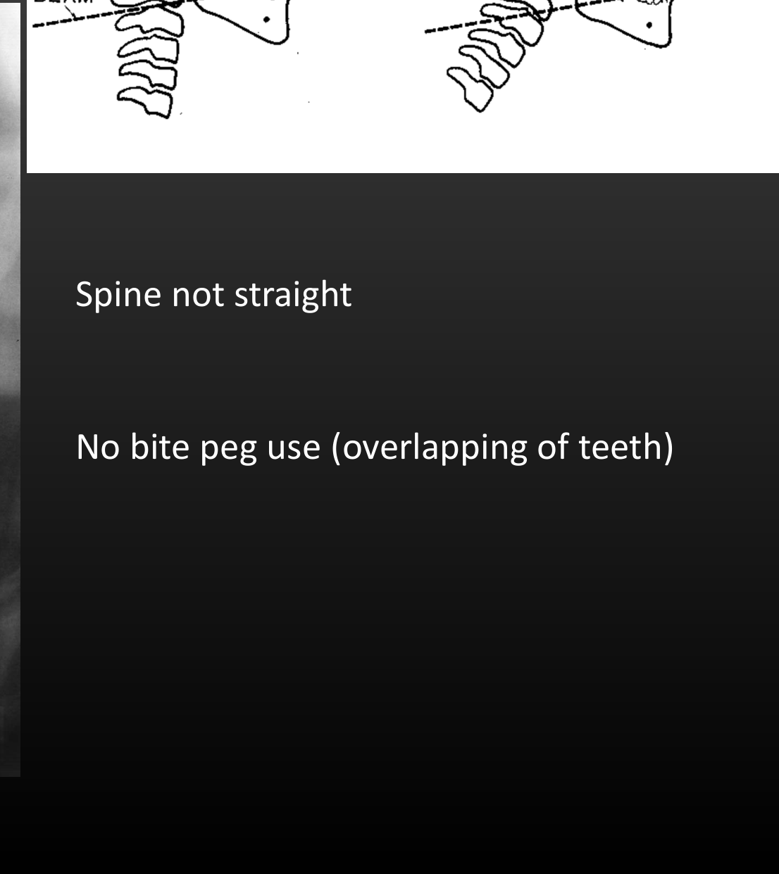 Spine not straight No bite peg use (overlapping of teeth)