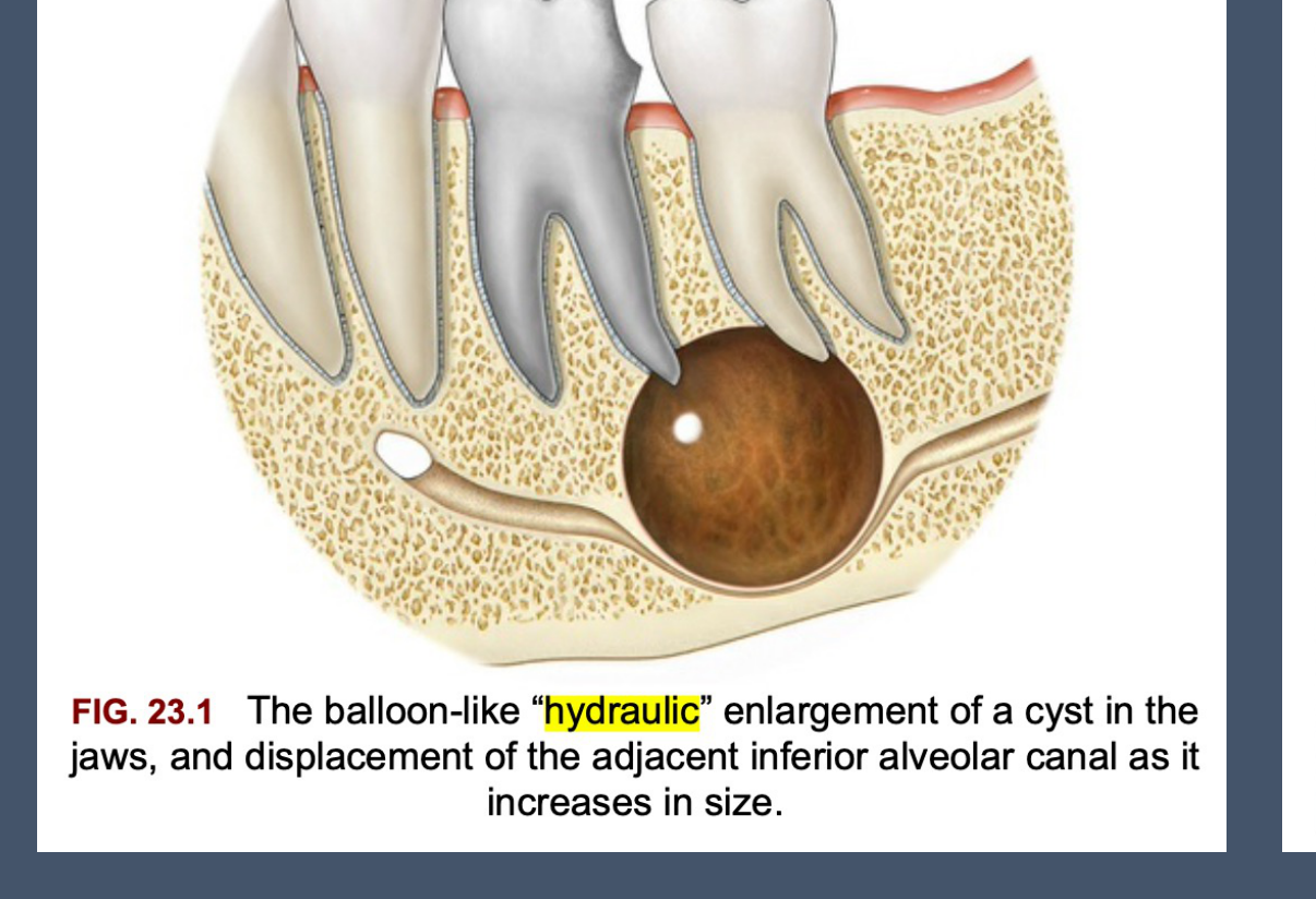 FIG. 23.1 The balloon-like "hydraulic" enlargement of a cyst in the jaws, and displacement of the adjacent inferior alveolar canal as it increases in size.