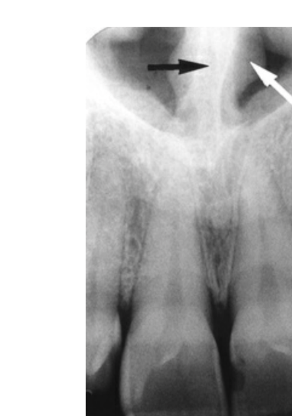 FIG. 12.23 The nasal septum (black arrow) arises directly above the anterior nasal spine and is covered on each side by mucosa (white arrow).
