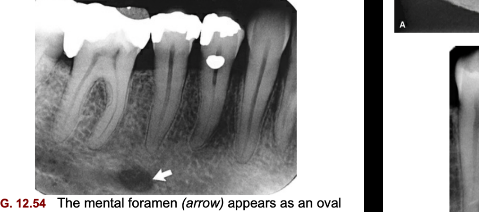 FIG. 12.54 The mental foramen (arrow) appears as an oval radiolucency typically near the apex of the second premolar.