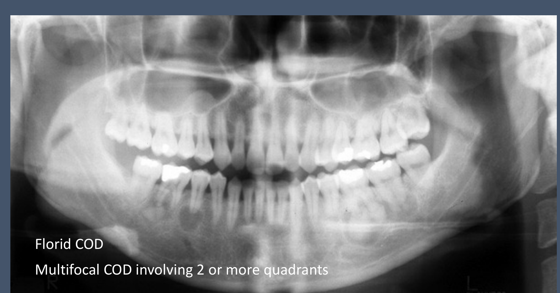 Florid COD Multifocal COD involving 2 or more quadrants