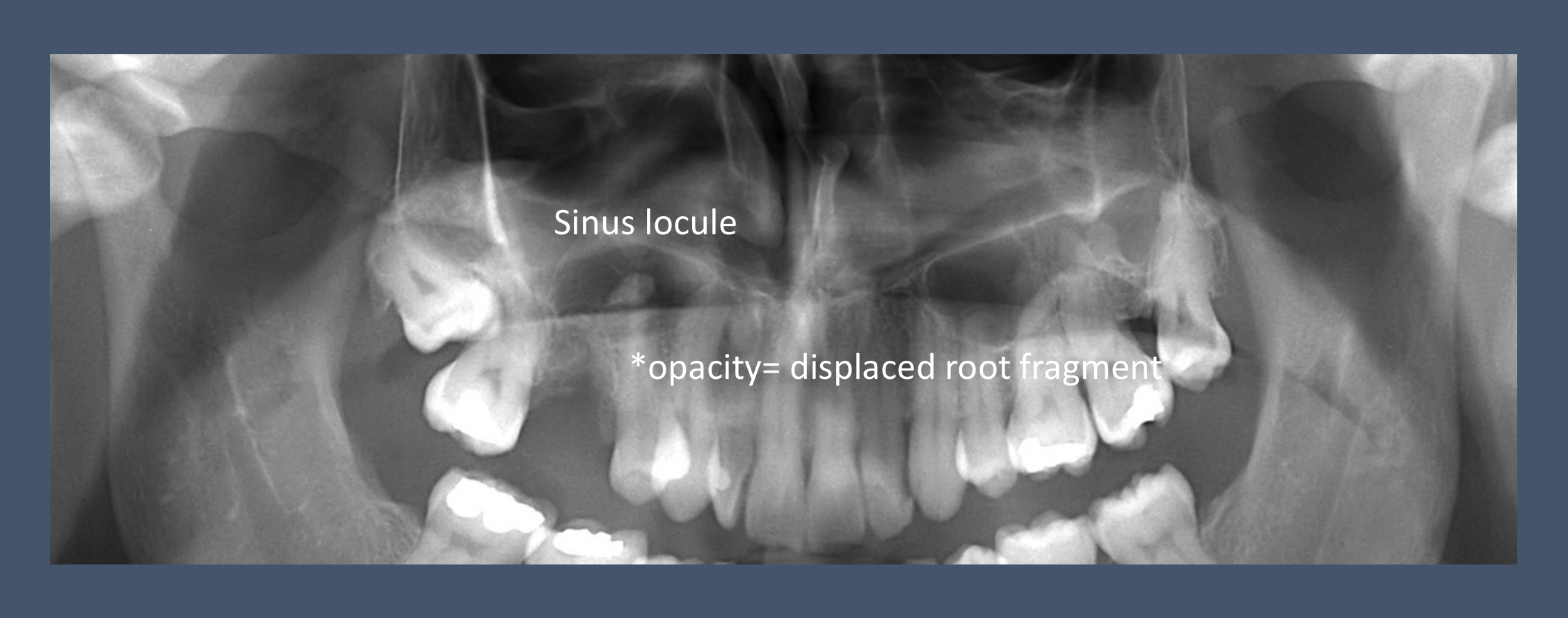 Sinus locule *opacity= displaced root fragment