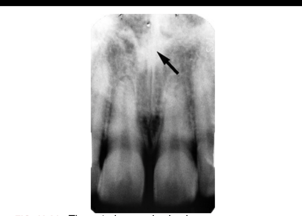FIG. 12.21 The anterior nasal spine is seen as an opaque, irregular, or V-shaped projection from the floor of the nasal aperture in the midline (arrow).