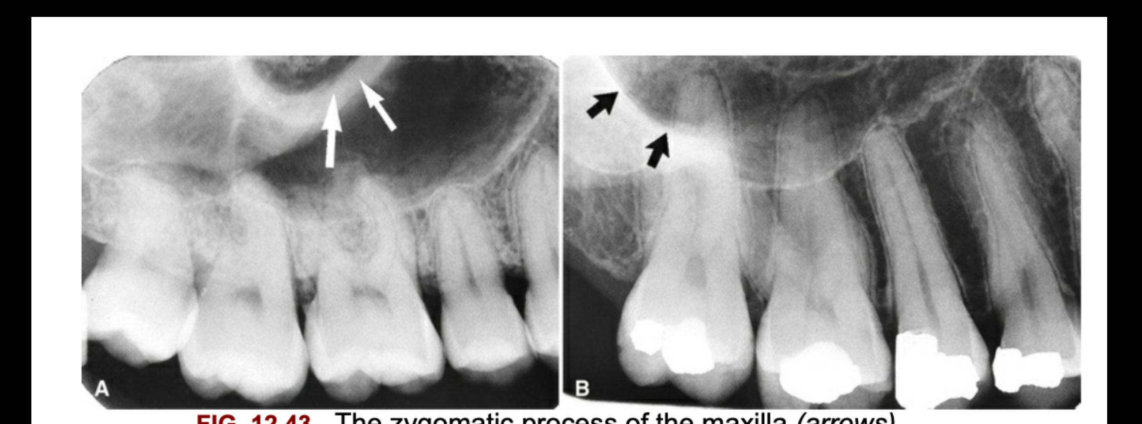 FIG. 12.43 The zygomatic process of the maxilla (arrows) protrudes laterally from the maxillary wall. Its size may be quite variable: small with thick borders (A) or large with thin borders (B).