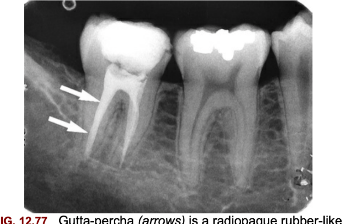 FIG. 12.77 Gutta-percha (arrows) is a radiopaque rubber-like material used in endodontic therapy.