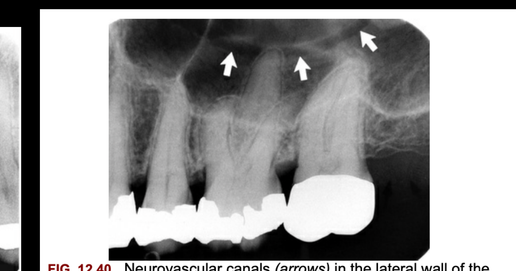 FIG. 12.40 Neurovascular canals (arrows) in the lateral wall of the maxillary sinus. Such vascular canals, although typically less prominent, are commonly seen in the walls of the normal maxillary sinus.