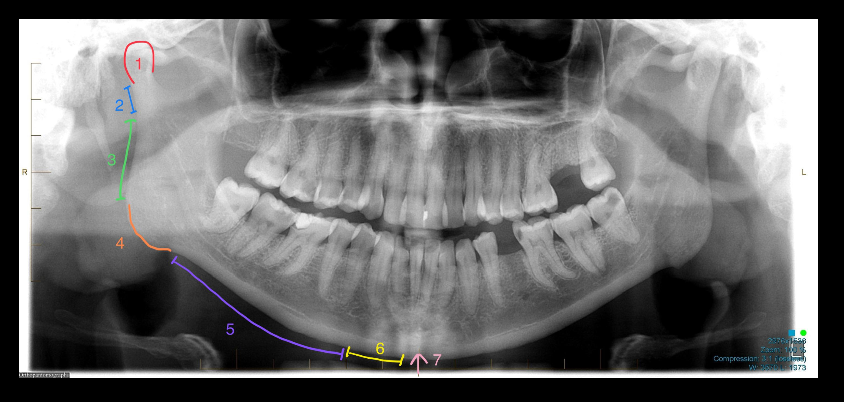 Case 3 – Regions of the Mandible