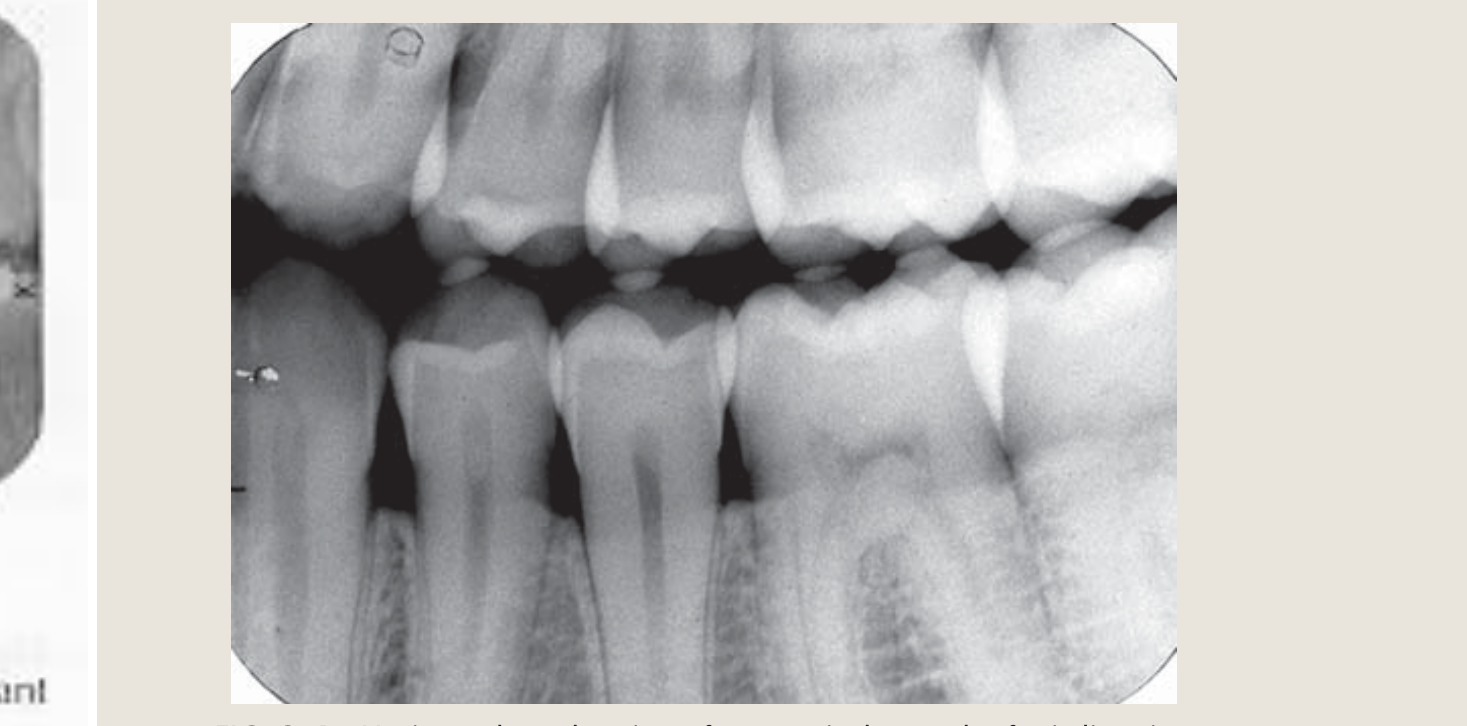 FIG. 9-4 Horizontal overlapping of crowns is the result of misdirection of the central ray.