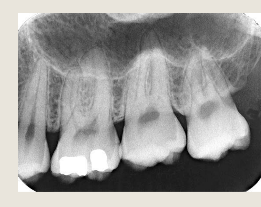 Upper (or Maxillary) Left Posterior Periapical (PA)