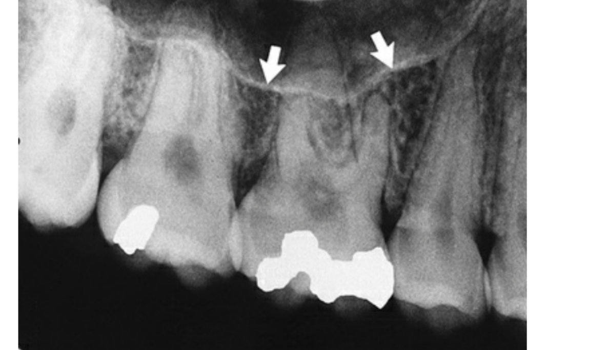 FIG. 12.36 The inferior border of the maxillary sinus (arrows) appears as a thin radiopaque line near the apices of the maxillary premolars and molars.