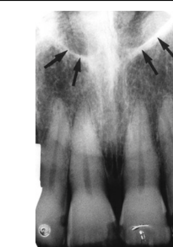 FIG. 12.22 The anterior floor of the nasal aperture (arrows) appears as opaque lines extending laterally from the anterior nasal spine.