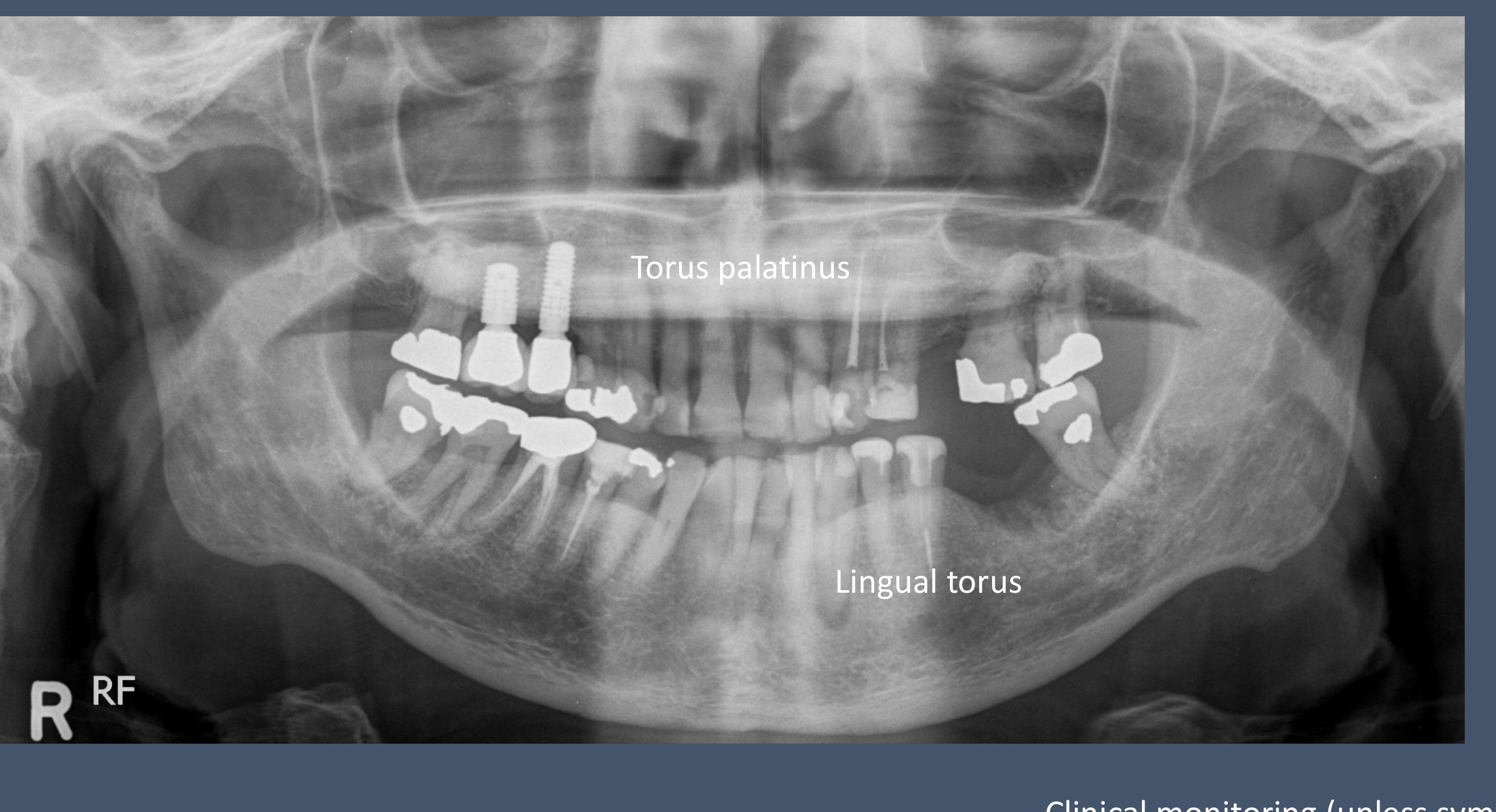 Tori & Exostoses are considered as an anatomical variant. Clinical monitoring (unless symptomatic)