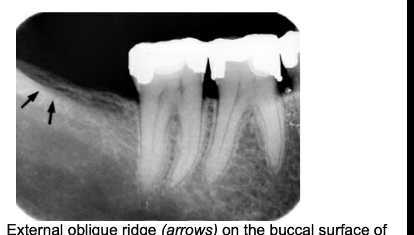 FIG. 12.65 External oblique ridge (arrows) on the buccal surface of the mandible, seen as a radiopaque line near the alveolar crest in the mandibular third molar region.