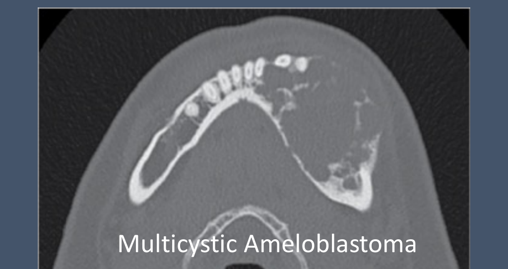 Multicystic Ameloblastoma